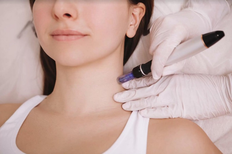 Dermapen-Tratamiento-para-Piel-Perfecta